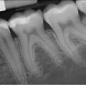 calcifiedcanals1