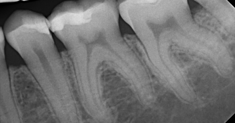 calcifiedcanals1