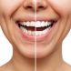 veneers-before-and-after