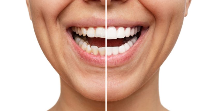 veneers-before-and-after